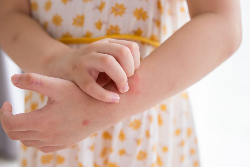 Alergia a los detergentes: tipos de reacciones - Norit
